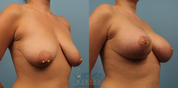 Before & After Breast Augmentation and Lift Case 202 View #2 View in Vancouver, BC