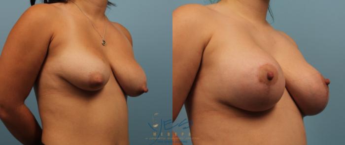 Before & After Breast Augmentation and Lift Case 204 View #2 View in Vancouver, BC