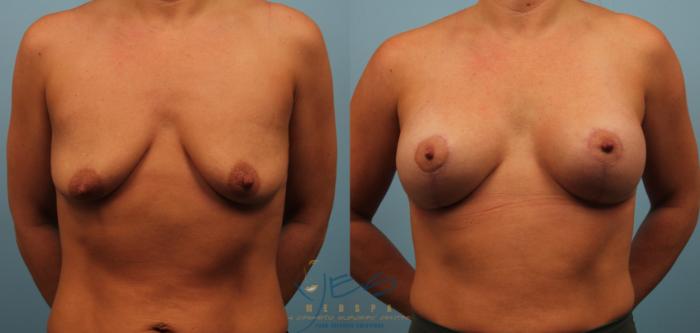 Before & After Breast Augmentation and Lift Case 228 View #1 View in Vancouver, BC
