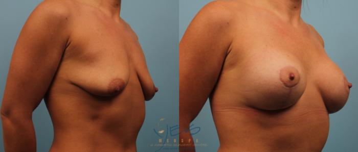 Before & After Breast Augmentation and Lift Case 228 View #2 View in Vancouver, BC