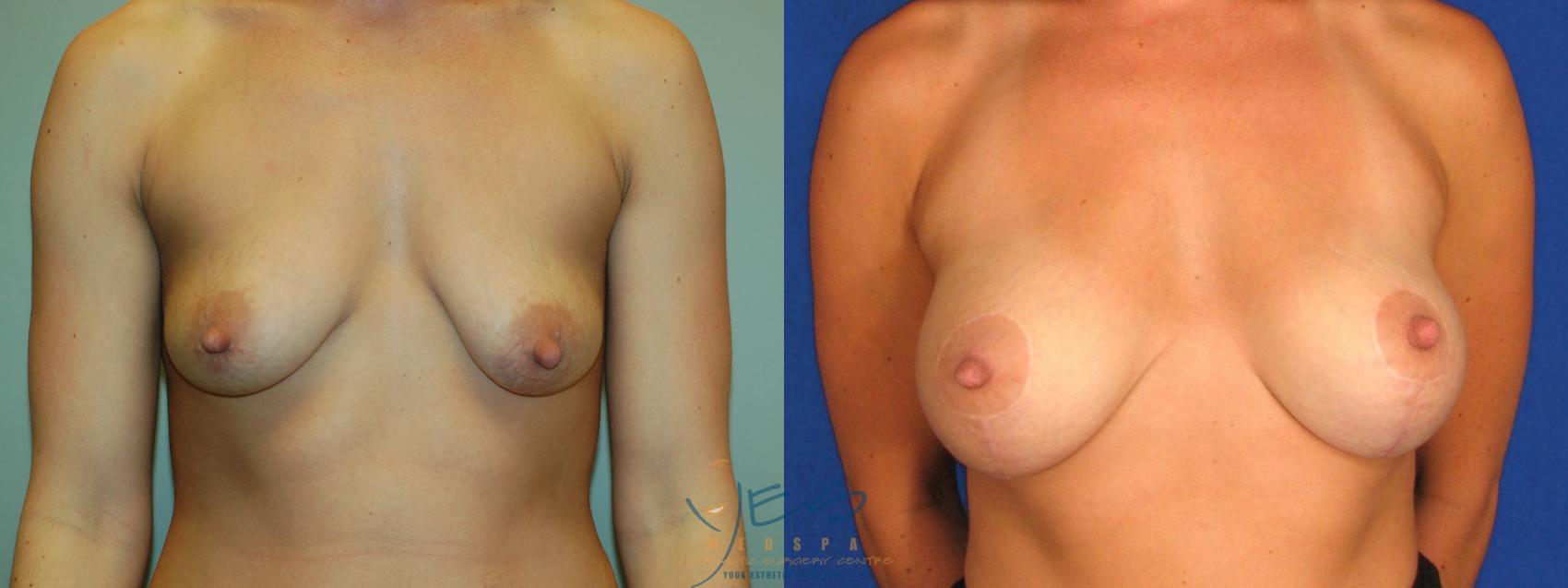 Before & After Breast Augmentation and Lift Case 26 Front View in Vancouver, BC
