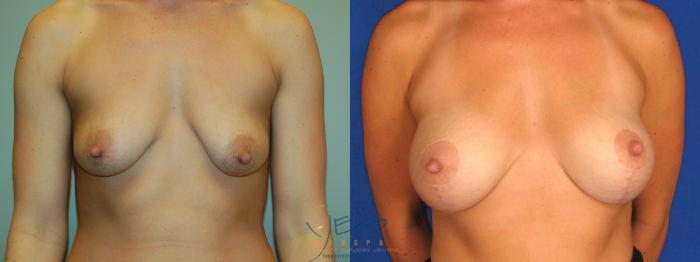 Before & After Breast Augmentation and Lift Case 26 Front View in Vancouver, BC