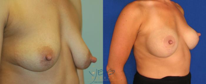 Before & After Breast Augmentation and Lift Case 26 Right Oblique View in Vancouver, BC
