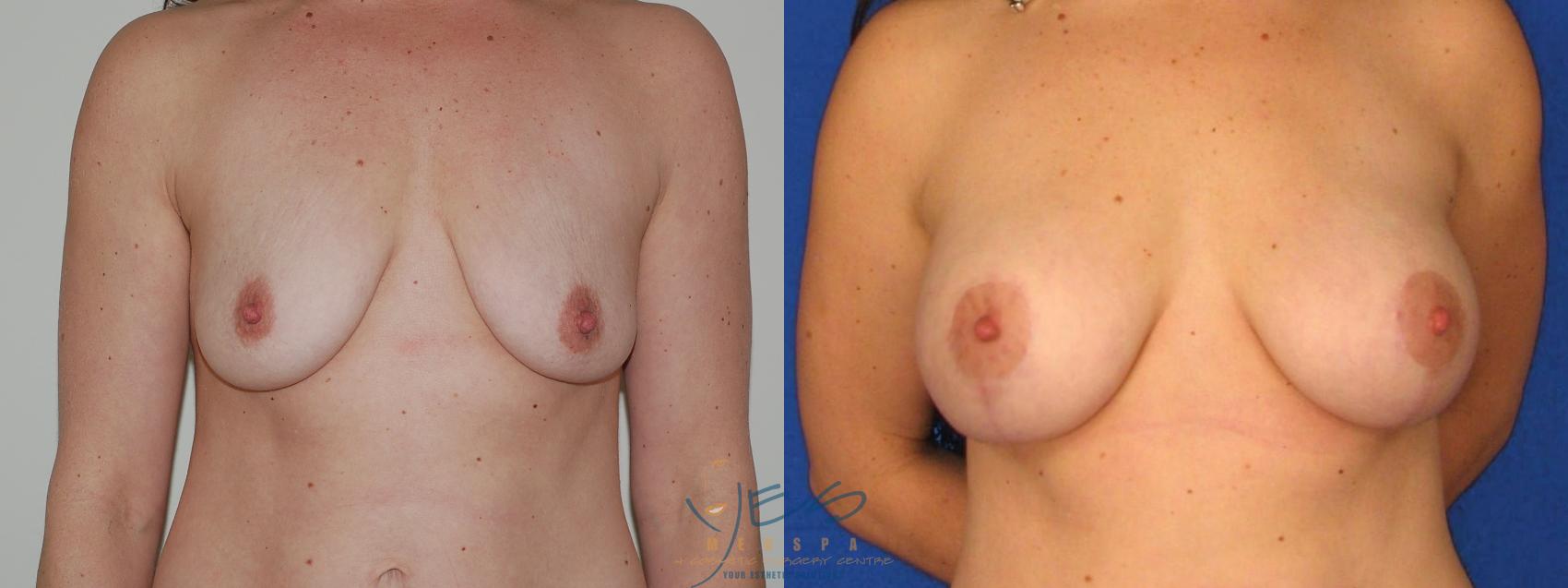 Before & After Breast Augmentation and Lift Case 30 View #1 View in Vancouver, BC