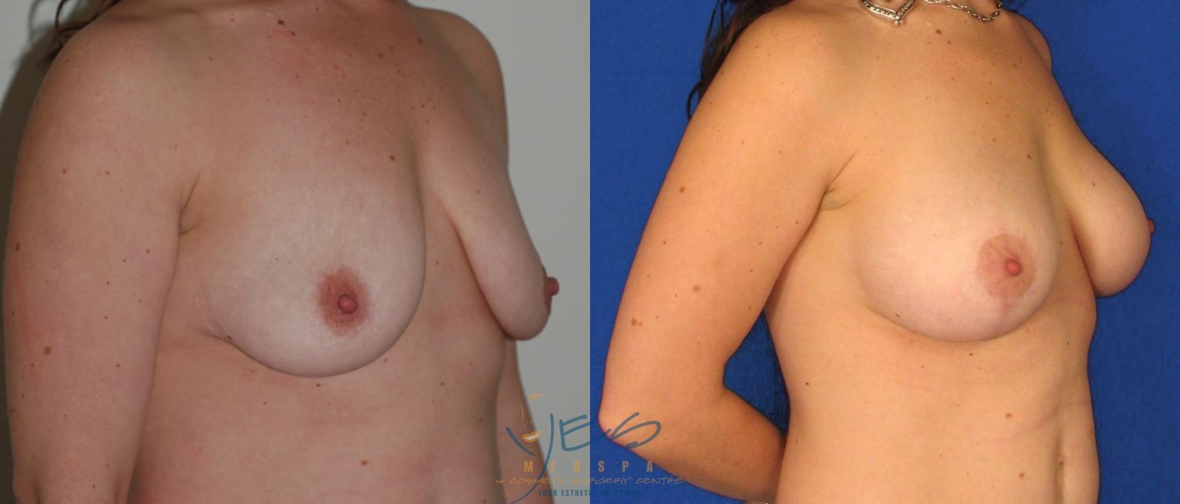 Before & After Breast Augmentation and Lift Case 30 View #2 View in Vancouver, BC