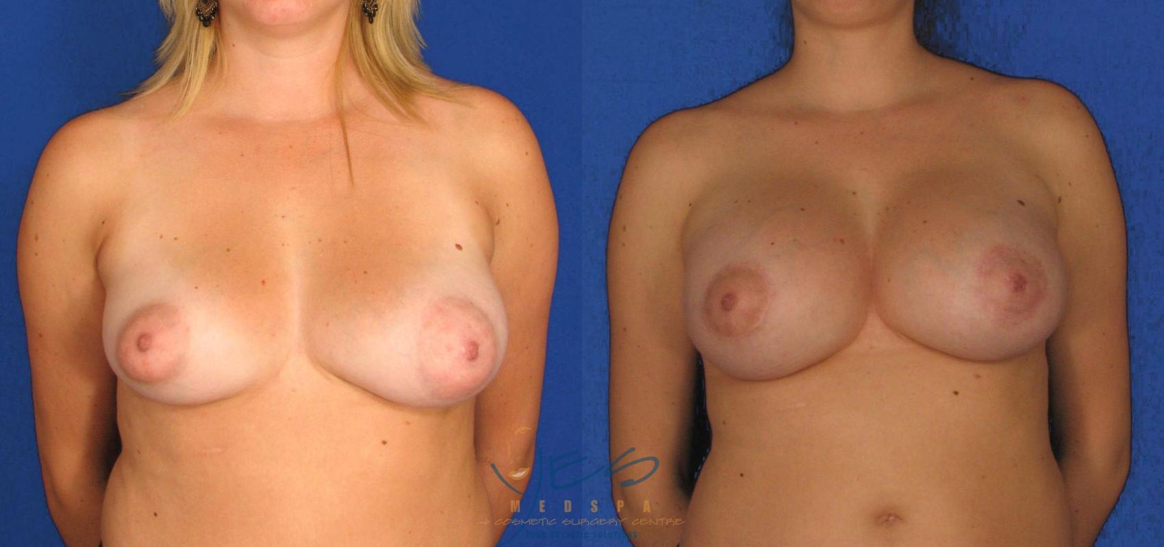 Before & After Breast Augmentation and Lift Case 31 View #1 View in Vancouver, BC