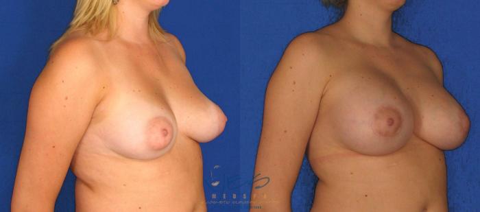 Before & After Breast Augmentation and Lift Case 31 View #2 View in Vancouver, BC