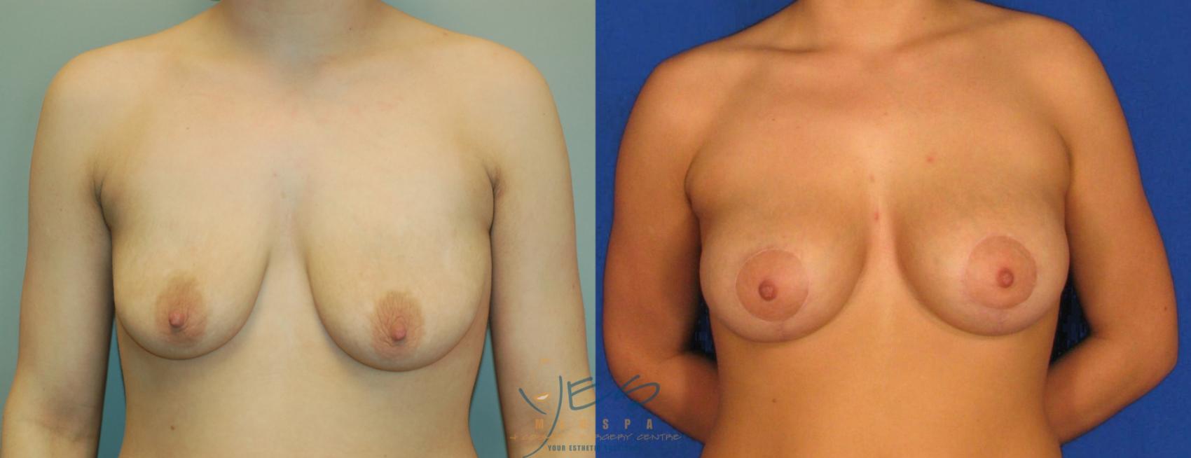 Before & After Breast Augmentation and Lift Case 32 View #1 View in Vancouver, BC