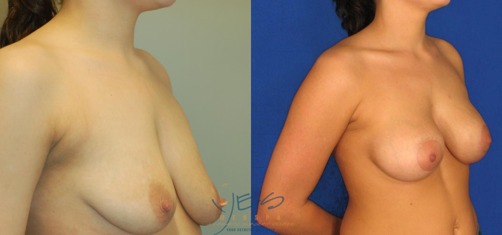 Before & After Breast Augmentation and Lift Case 32 View #2 View in Vancouver, BC