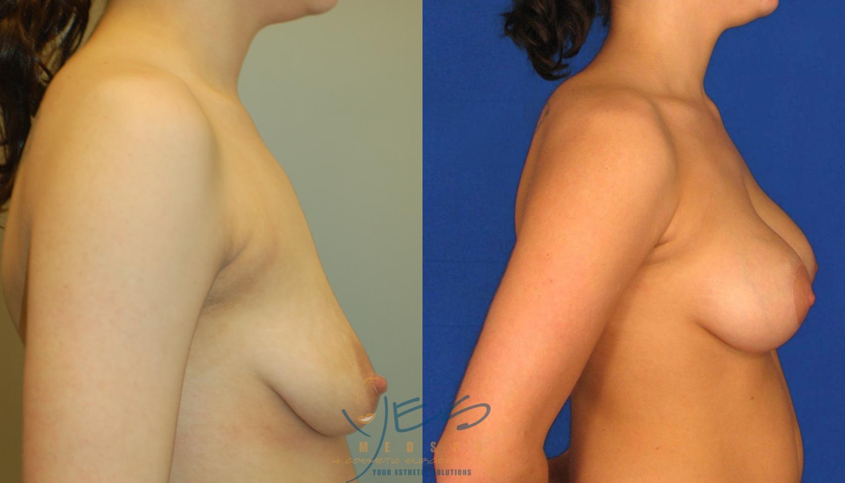Before & After Breast Augmentation and Lift Case 32 View #3 View in Vancouver, BC