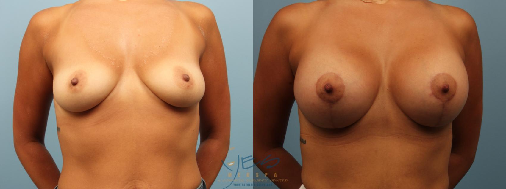 Before & After Breast Augmentation and Lift Case 339 Front View in Vancouver, BC