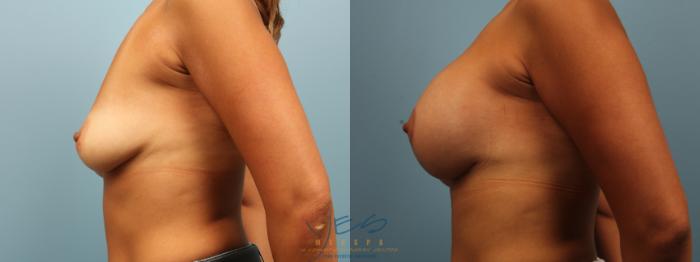 Before & After Breast Augmentation and Lift Case 339 Left Side View in Vancouver, BC