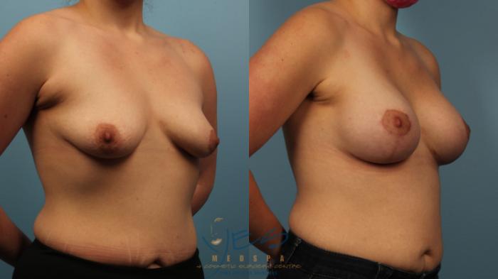 Before & After Breast Augmentation and Lift Case 371 Right Oblique View in Vancouver, BC