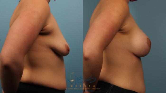 Before & After Breast Augmentation and Lift Case 371 Right Side View in Vancouver, BC