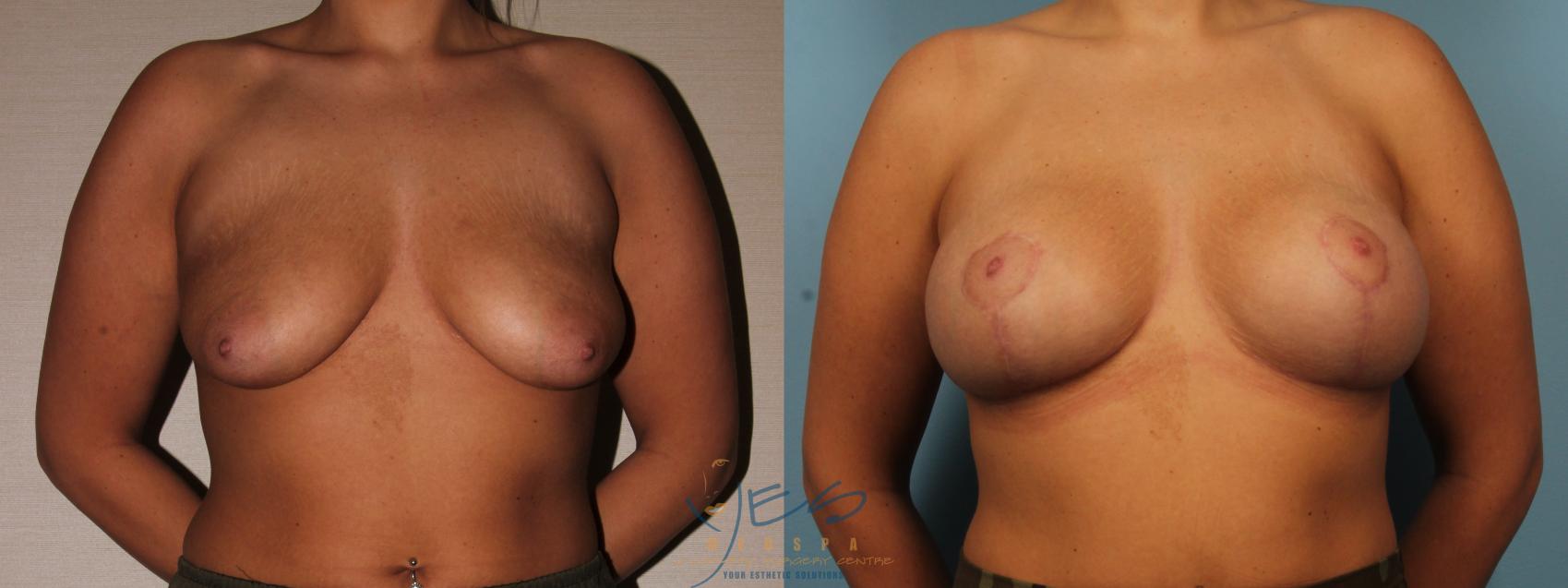 Before & After Breast Augmentation and Lift Case 372 Front View in Vancouver, BC