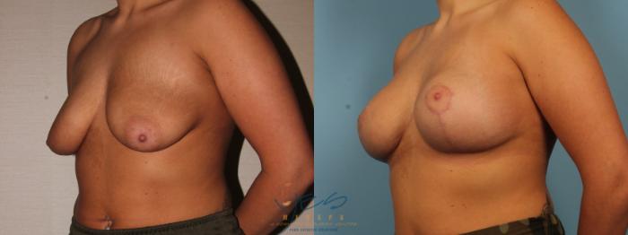 Before & After Breast Augmentation and Lift Case 372 Left Oblique View in Vancouver, BC