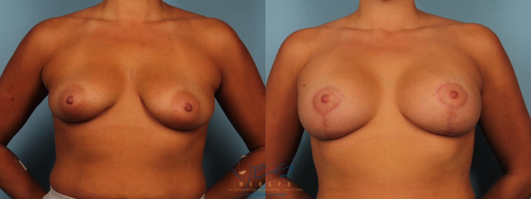 Before & After Breast Augmentation and Lift Case 380 Front View in Vancouver, BC