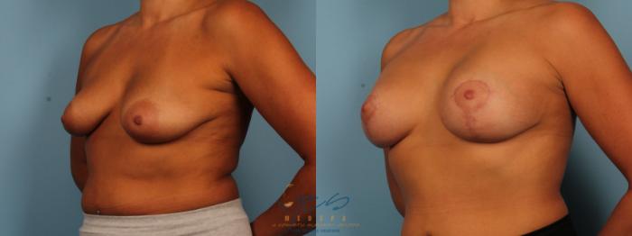Before & After Breast Augmentation and Lift Case 380 Left Oblique View in Vancouver, BC
