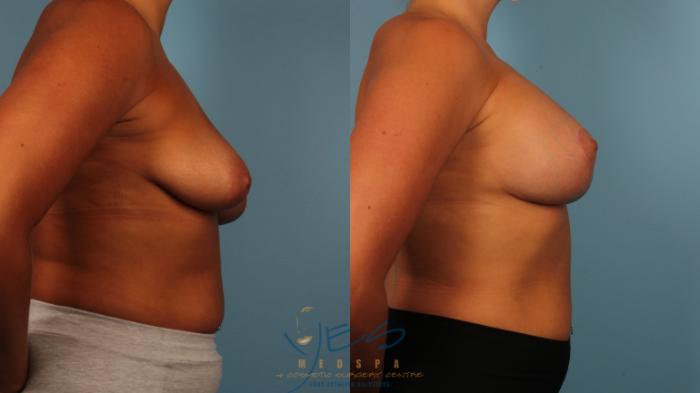 Before & After Breast Augmentation and Lift Case 380 Right Side View in Vancouver, BC