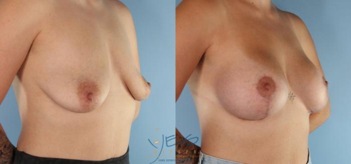 Before & After Breast Augmentation and Lift Case 455 Left Side View in Vancouver, BC