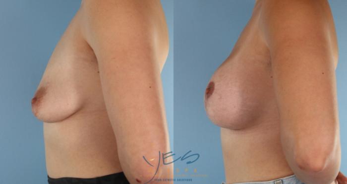 Before & After Breast Augmentation and Lift Case 455 Right Oblique View in Vancouver, BC