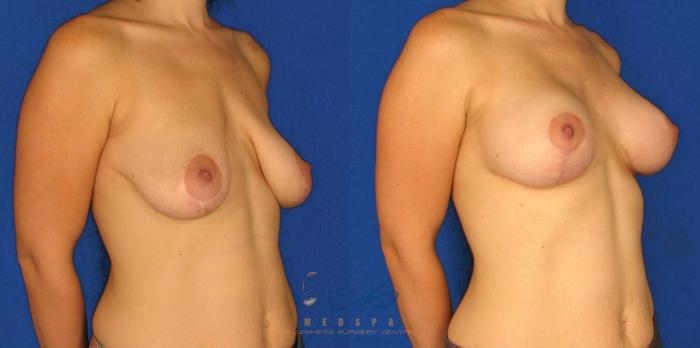 Before & After Breast Augmentation and Lift Case 51 View #2 View in Vancouver, BC