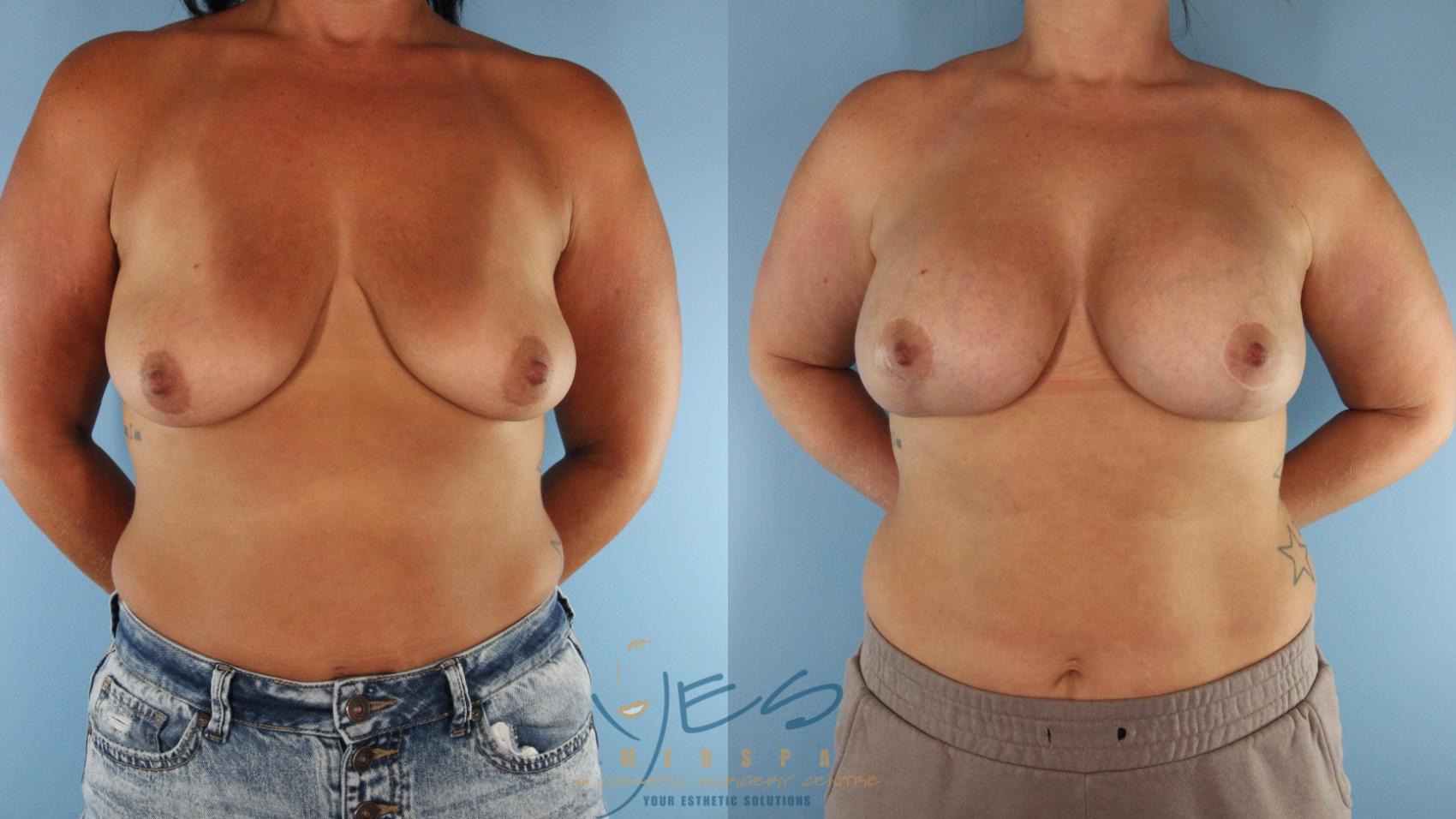 Before & After Breast Augmentation and Lift Case 530 Front View in Vancouver, BC