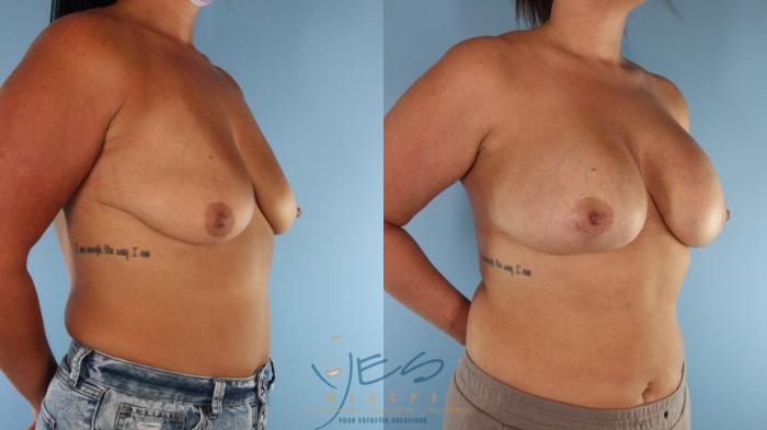 Before & After Breast Augmentation and Lift Case 530 Left Oblique View in Vancouver, BC