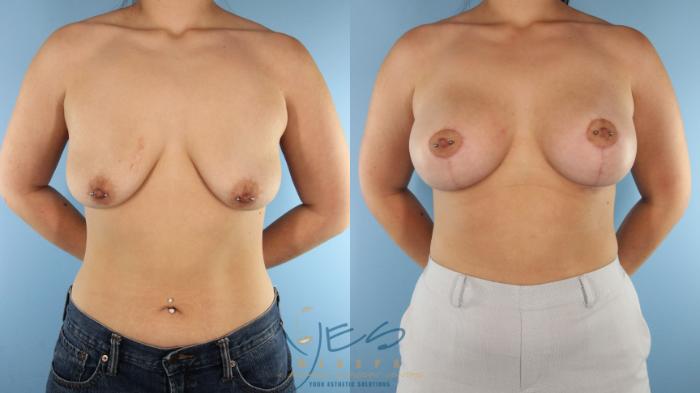 Before & After Breast Augmentation and Lift Case 565 Left Side View in Vancouver, BC