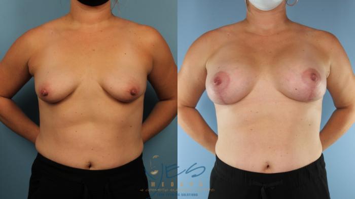 Before & After Breast Augmentation and Lift Case 566 Front View in Vancouver, BC