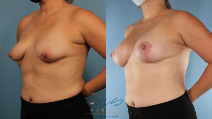 Before & After Breast Augmentation and Lift Case 566 Left Oblique View in Vancouver, BC