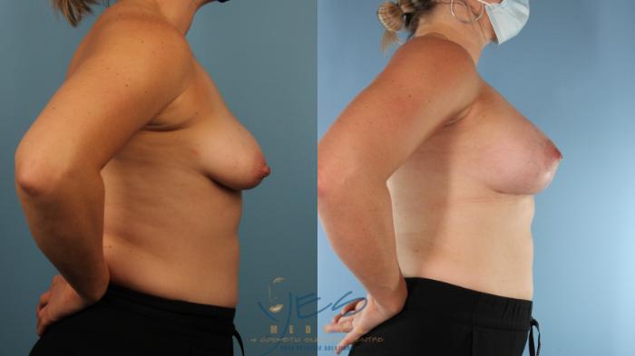 Before & After Breast Augmentation and Lift Case 566 Right Side View in Vancouver, BC