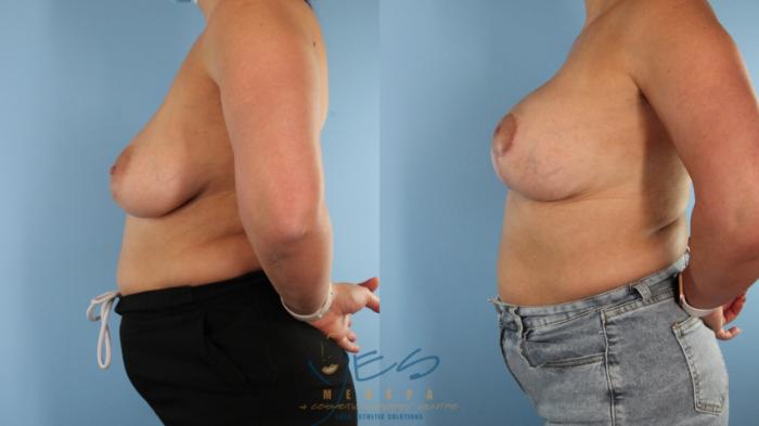 Before & After Breast Augmentation and Lift Case 567 Left Side View in Vancouver, BC