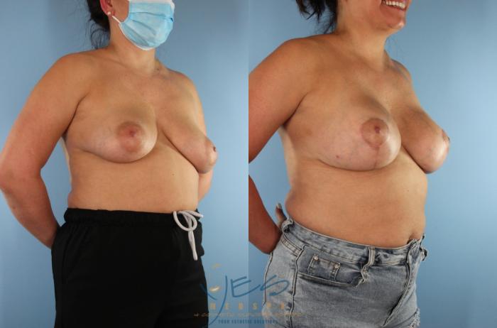 Before & After Breast Augmentation and Lift Case 567 Right Oblique View in Vancouver, BC