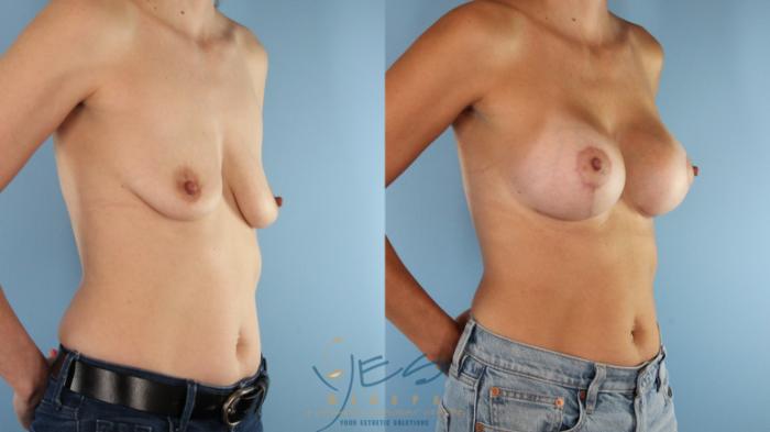 Before & After Breast Augmentation and Lift Case 597 Right Oblique View in Vancouver, BC
