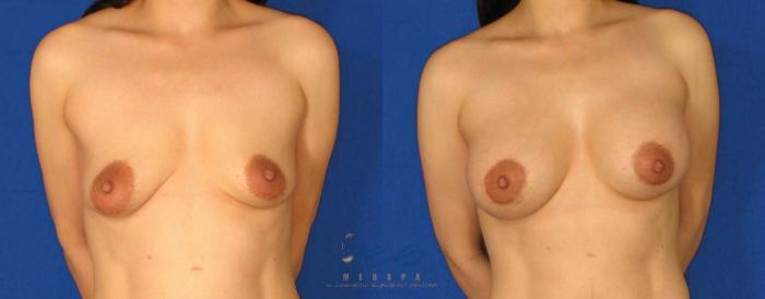Before & After Breast Augmentation and Lift Case 67 View #1 View in Vancouver, BC