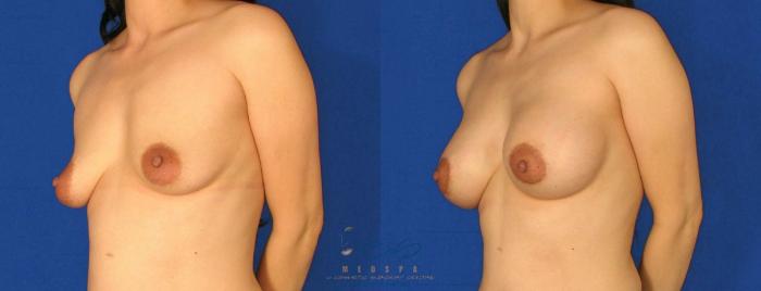Before & After Breast Augmentation and Lift Case 67 View #2 View in Vancouver, BC