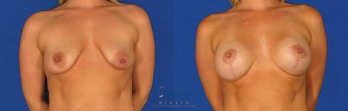 Before & After Breast Augmentation and Lift Case 79 View #1 View in Vancouver, BC