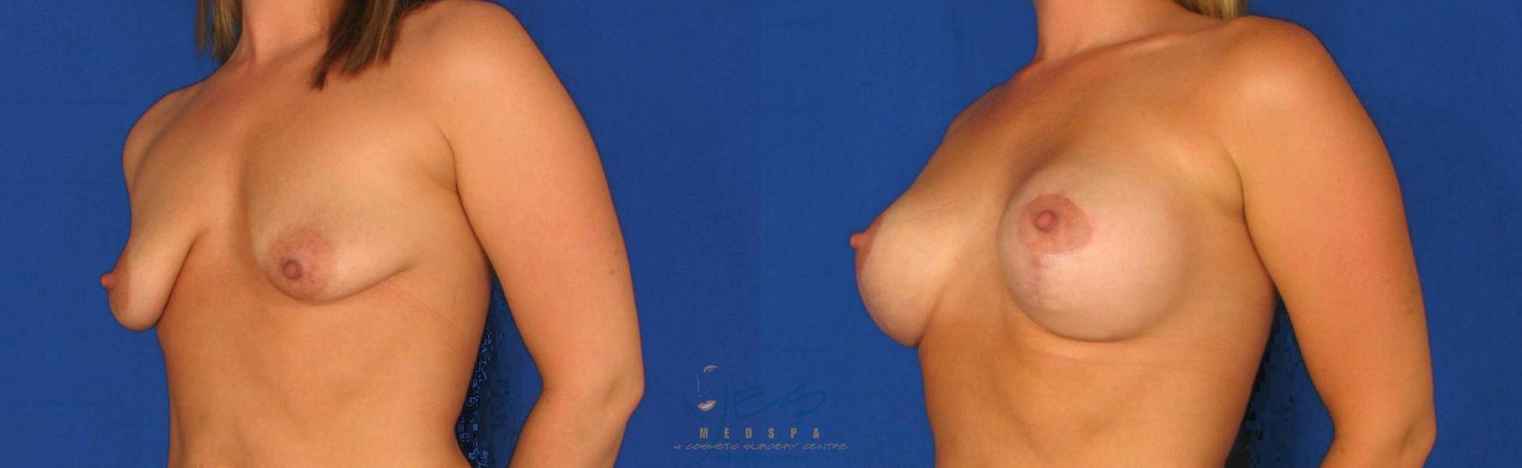 Before & After Breast Augmentation and Lift Case 79 View #2 View in Vancouver, BC