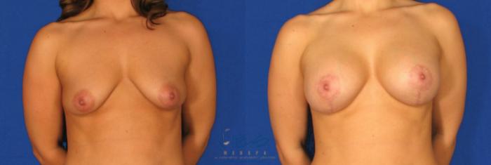 Before & After Breast Augmentation and Lift Case 81 View #1 View in Vancouver, BC