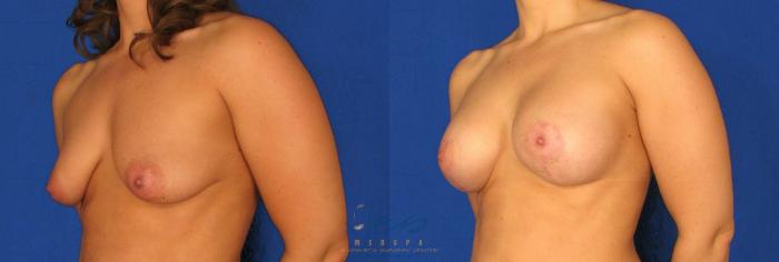 Before & After Breast Augmentation and Lift Case 81 View #2 View in Vancouver, BC