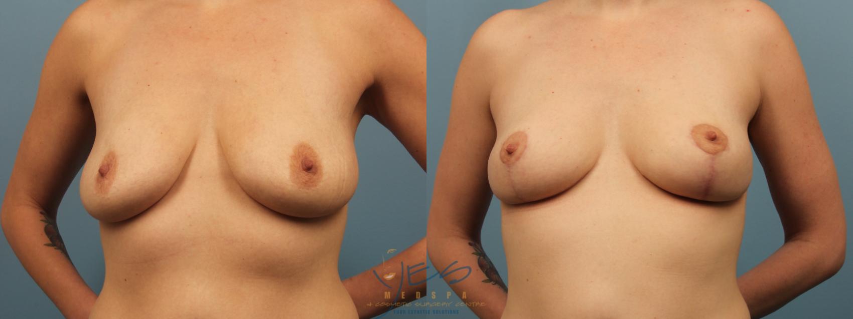 Before & After Breast Lift Case 274 Front View in Vancouver, BC