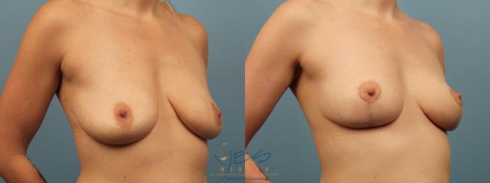 Before & After Breast Lift Case 274 Right Oblique View in Vancouver, BC