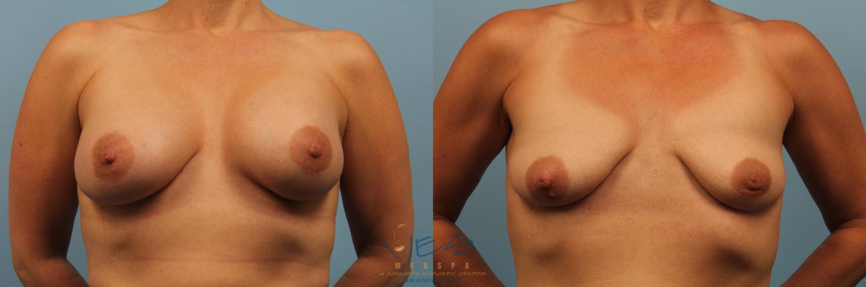 Before & After Breast Implant Removal Case 188 View #1 View in Vancouver, BC