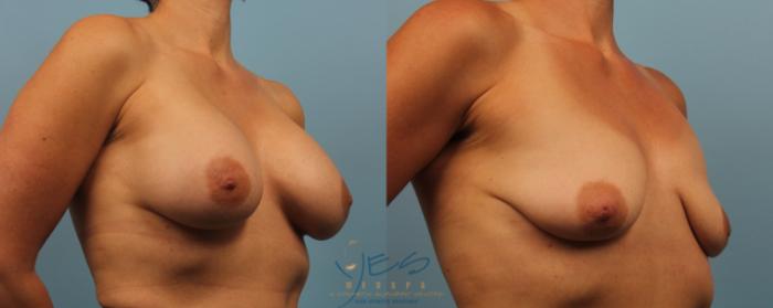 Before & After Breast Implant Removal Case 188 View #2 View in Vancouver, BC