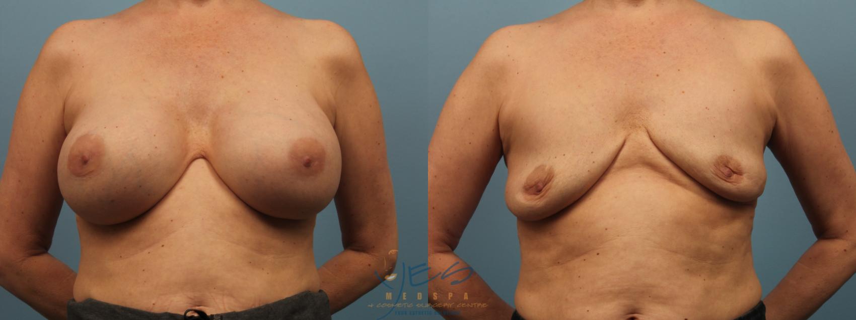 Before & After Breast Implant Removal Case 306 Front View in Vancouver, BC