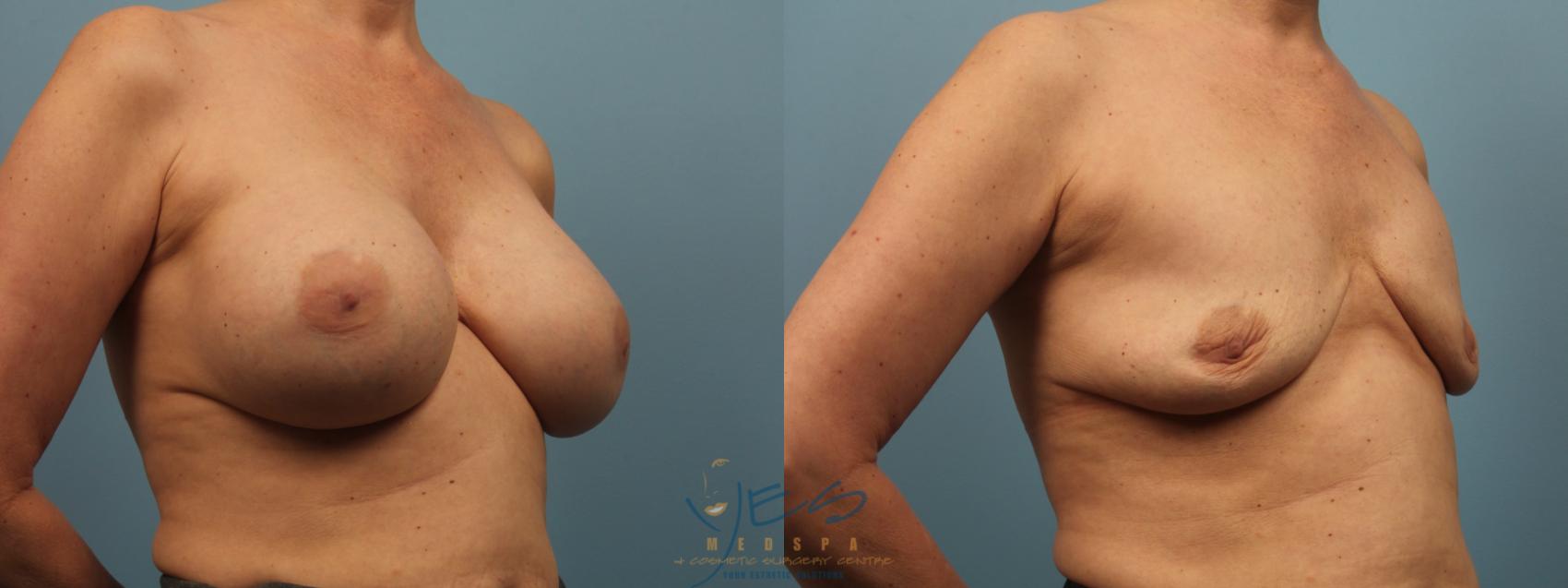 Before & After Breast Implant Removal Case 306 Right Oblique View in Vancouver, BC