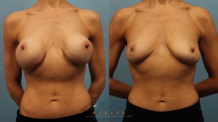 Before & After Breast Implant Removal Case 320 Front View in Vancouver, BC