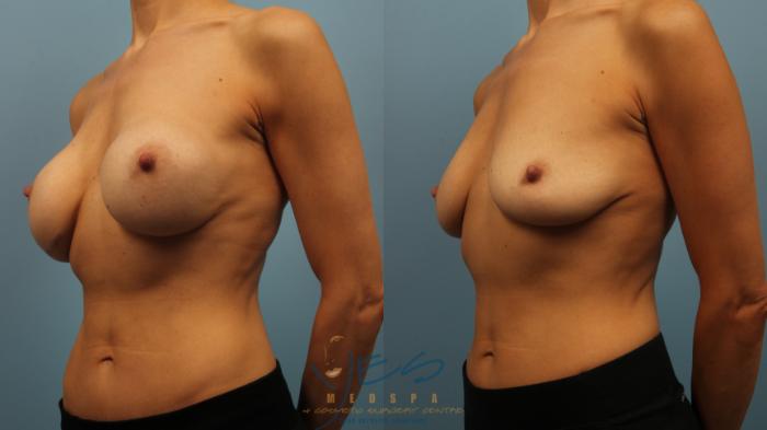 Before & After Breast Implant Removal Case 320 Left Oblique View in Vancouver, BC
