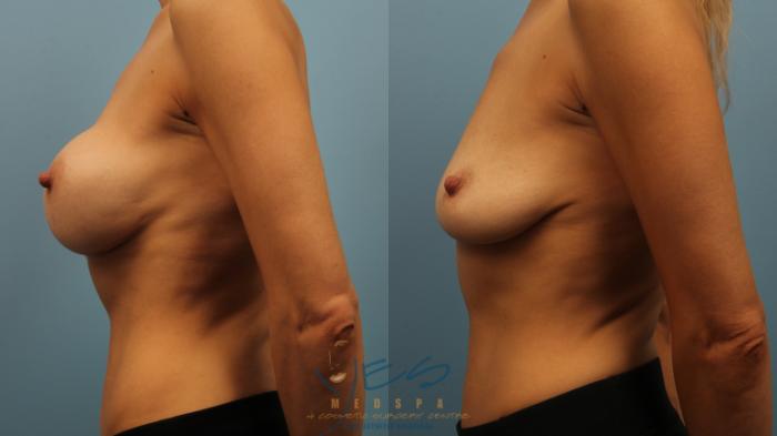 Before & After Revision Breast Surgery Case 320 Left Side View in Vancouver, BC